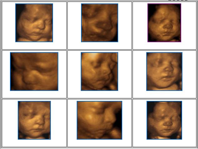 4d Ultrasound Pictures.